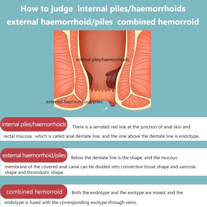 SERYNTH Hemorrhoid and Anal Fissure Ointment, Hemorrhoid Treatment, Fast Relief from Swelling, Pain, Itching, Burning (20g) SERYNTHBuy Supplements Australia