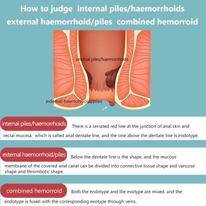 SERYNTH Hemorrhoid and Anal Fissure Ointment, Hemorrhoid Treatment, Fast Relief from Swelling, Pain, Itching, Burning (20g) SERYNTHBuy Supplements Australia