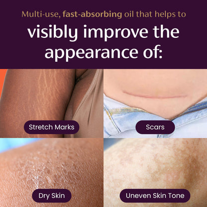 Mederma Quick Dry Oil, Scar and Stretch Mark Treatment, Helps to Improve the Appearance with Natural Botanical Extracts, Paraben Free, Fast-Absorbing, 3.4oz (100ml) MedermaBuy Supplements Australia