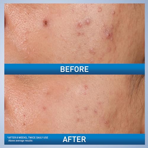 CeraVe Acne Control Gel, 2% Salicylic Acid Treatment With Glycolic Acid + Lactic Acids - PrimeBioHealth - canada supplements