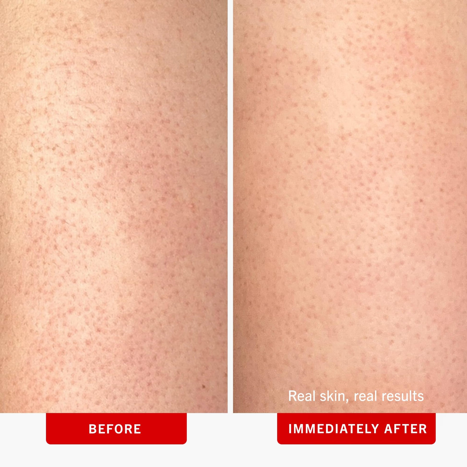 First Aid Beauty - KP Bump Eraser Body Scrub with 10% AHA, Keratosis Pilaris Exfoliator with Glycolic and Lactic acids, Helps Reduce Chicken Skin Bumps - PrimeBioHealth - canada supplements