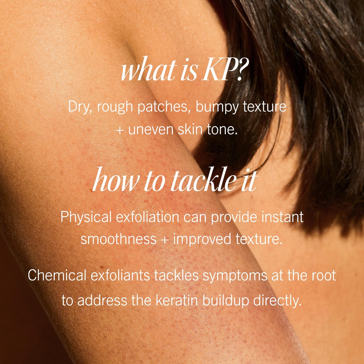 First Aid Beauty - KP Bump Eraser Body Scrub with 10% AHA, Keratosis Pilaris Exfoliator with Glycolic and Lactic acids, Helps Reduce Chicken Skin Bumps - PrimeBioHealth - canada supplements