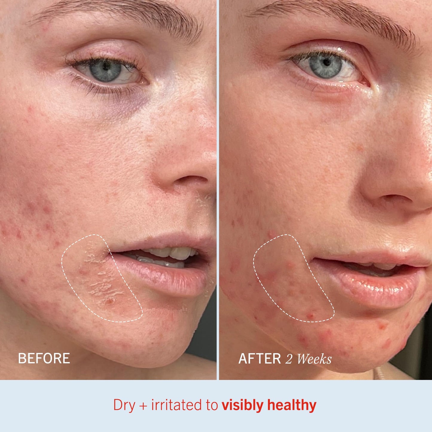 First Aid Beauty - Ultra Repair Cream, Intense Hydration Whipped Colloidal Oatmeal, Clinically Proven to Strengthen Skin Barrier in 7 Days - PrimeBioHealth - canada supplements