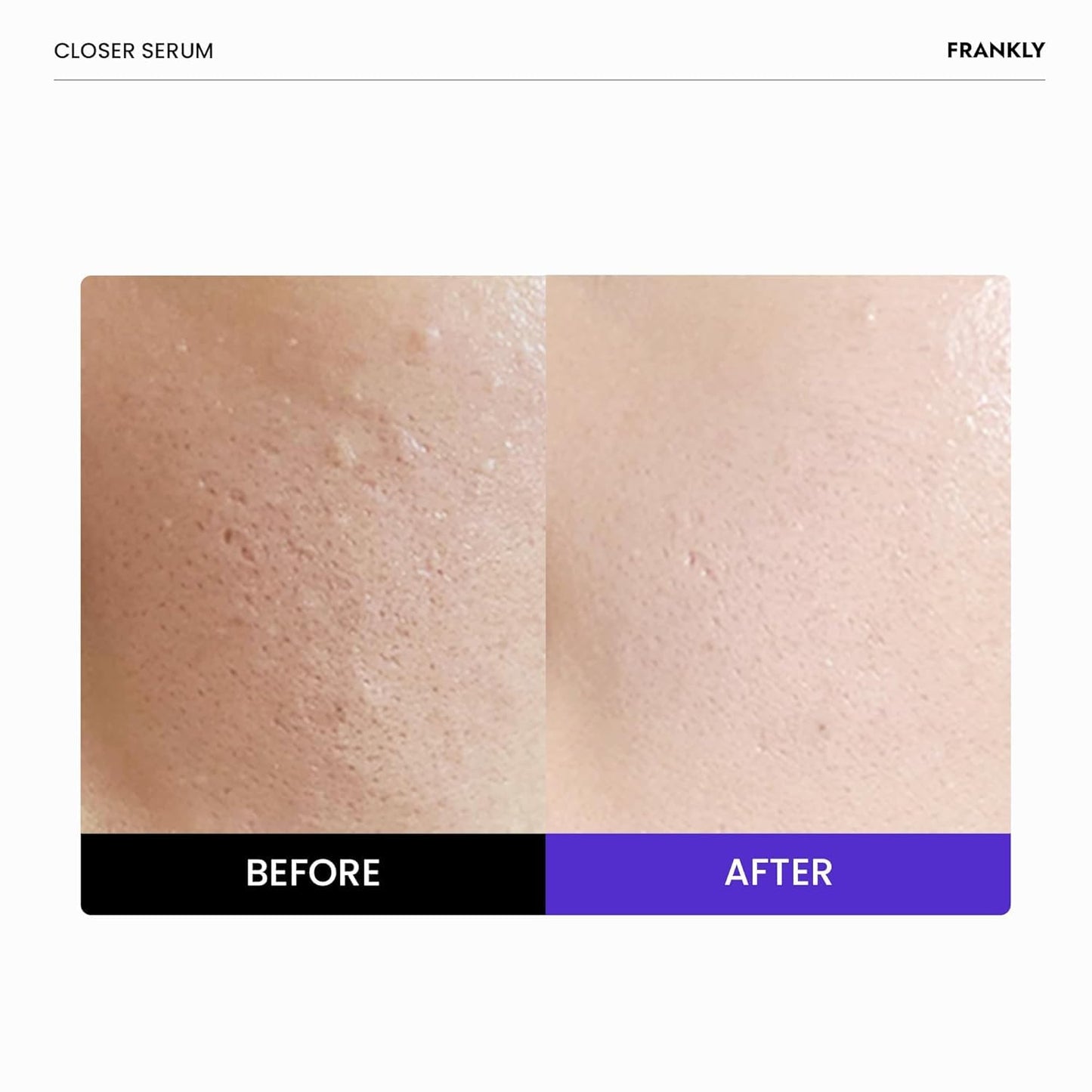 FRANKLY Closer Serum | Pore Minimizer Serum | 9 Peptides, Vegan Collagen, Adenosine, PHA | Korean Pore Minimizer for Glass Skin - PrimeBioHealth - canada supplements