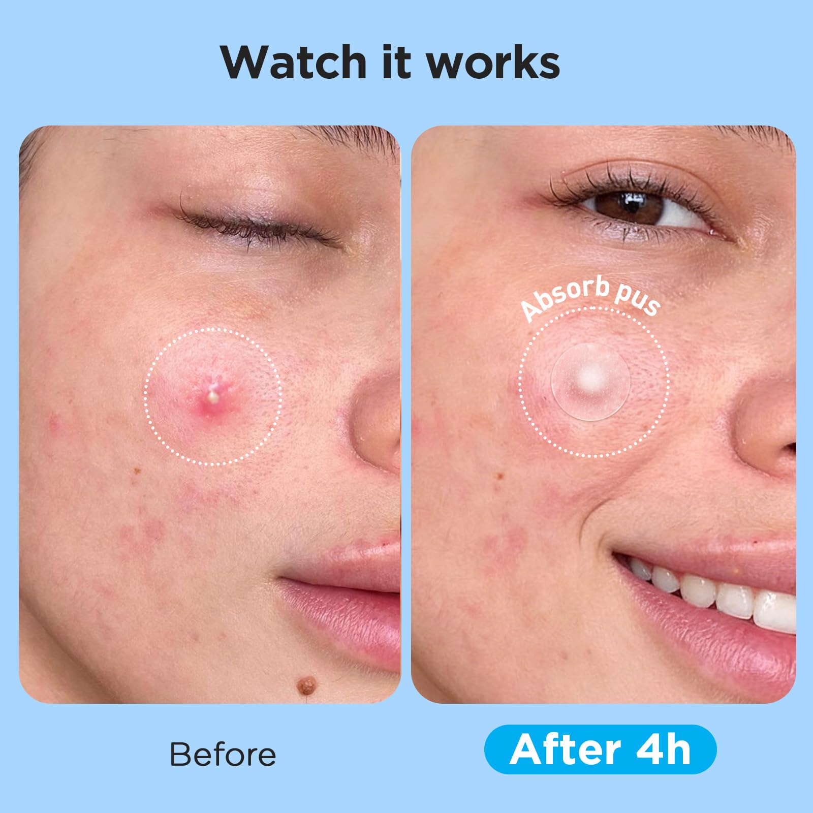 Glowpatch Pimple Patches for Face (504 Count), FSA Eligible Acne Patch Bulk, Zit Stickers 4 Sizes, Hydrocolloid Spot Stickers - PrimeBioHealth - canada supplements