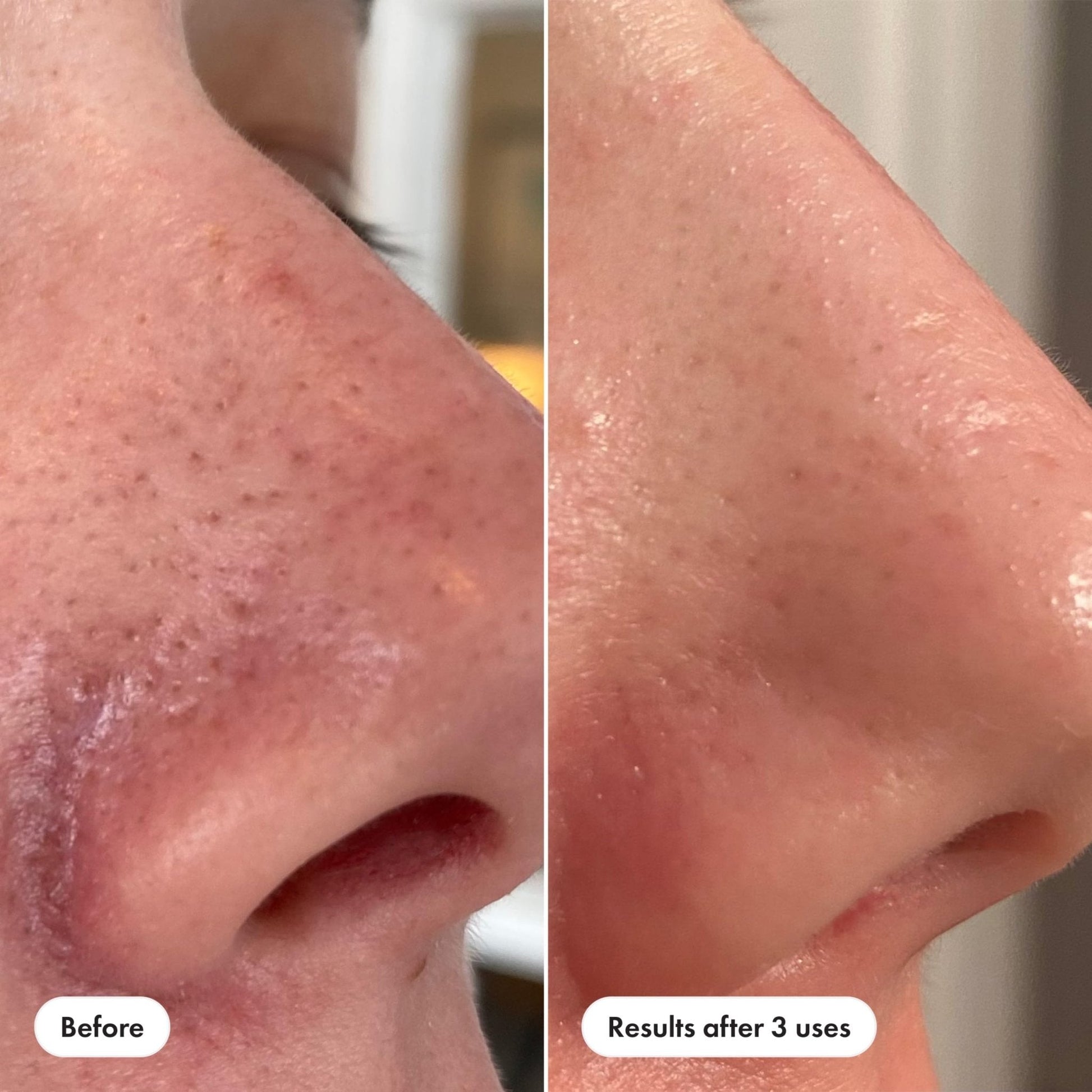Hero Cosmetics Pore Release Blackhead Clearing Solution, Exfoliating 2% Salicylic Acid Toner Featuring AHA, BHA, and PHA - PrimeBioHealth - canada supplements