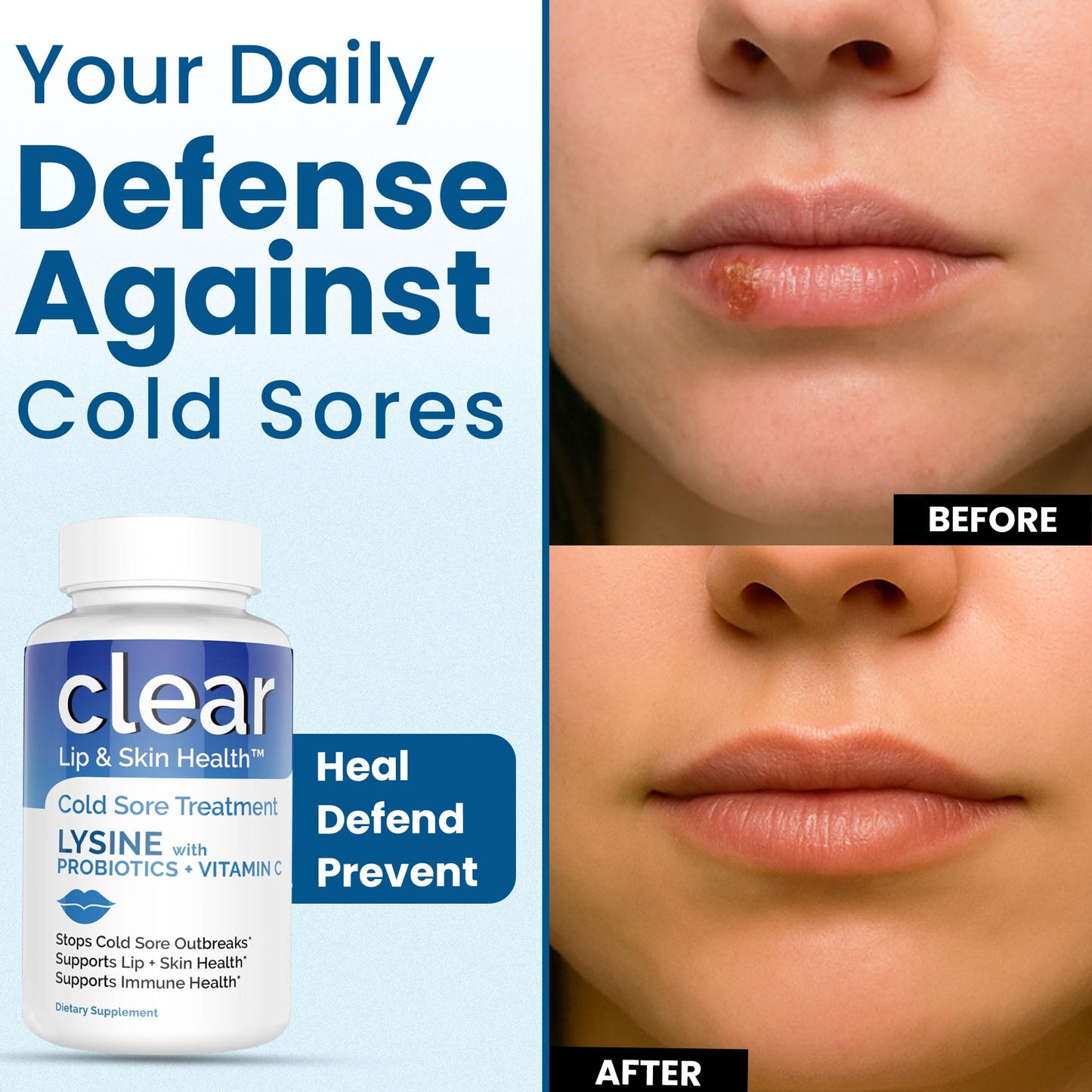 Lysine Cold Sore Treatment for Lips with Pre-Probiotics & VIT C | 1 Month Supply | Supercharged Lysine Capsules with Rhamnosus & Acidophilus for Cold Sores Relief - PrimeBioHealth - canada supplements