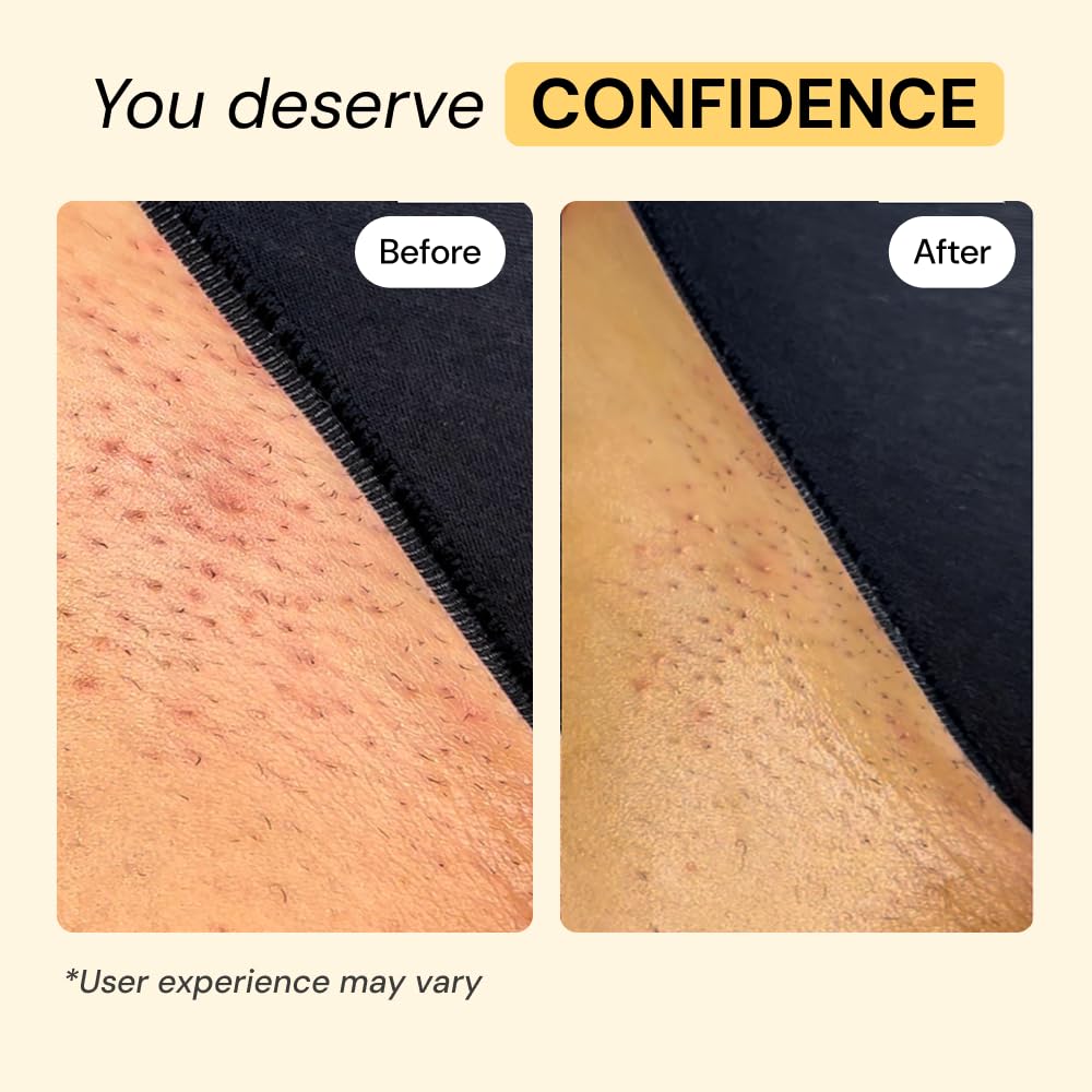 MyMagicHealer Thyme & Tea Tree Flare Care | Cystic Acne, Folliculitis, Ingrown Hair, Keratosis Pilaris, Razor Bumps, Body Bumps, Blind Pimples Multi-purpose Solution - PrimeBioHealth - canada supplements