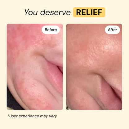 MyMagicHealer Universal Flare Care | Essential Oil Free | Baby Dermatitis, Diaper Rash, Eczema, Psoriasis, Impetigo | Wound Car - PrimeBioHealth - canada supplements