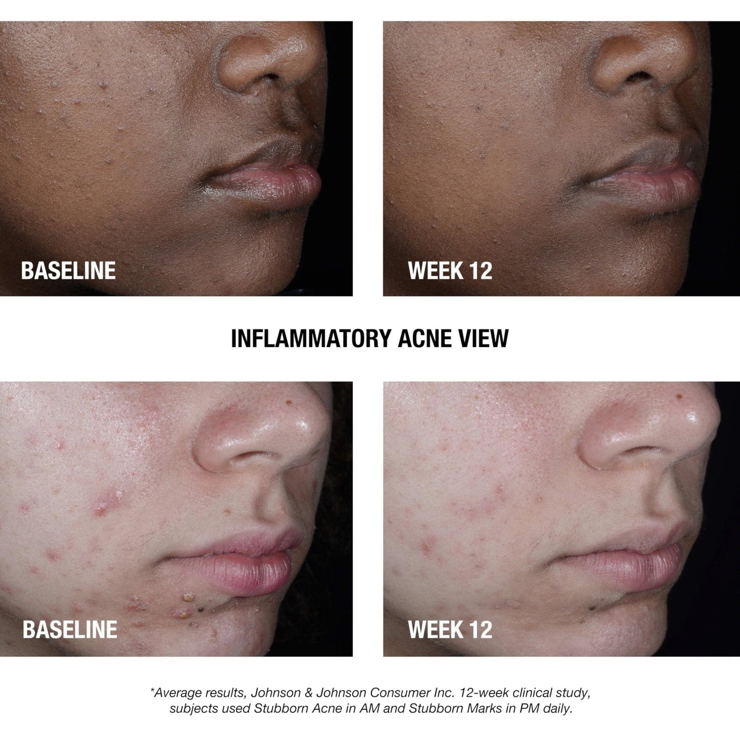 Neutrogena Stubborn Acne AM Face Treatment with 2.5% Micronized Benzoyl Peroxide Acne Medication, Oil-Free Daily Facial Treatment Reduces Size - PrimeBioHealth - canada supplements