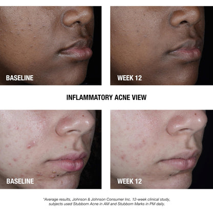 Neutrogena Stubborn Acne AM Face Treatment with 2.5% Micronized Benzoyl Peroxide Acne Medication, Oil-Free Daily Facial Treatment Reduces Size - PrimeBioHealth - canada supplements