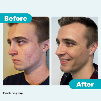 Proactiv Repair Acne Treatment Benzoyl Peroxide Spot Treatment and Repairing Serum Clear, 3 Fl Oz - PrimeBioHealth - canada supplements
