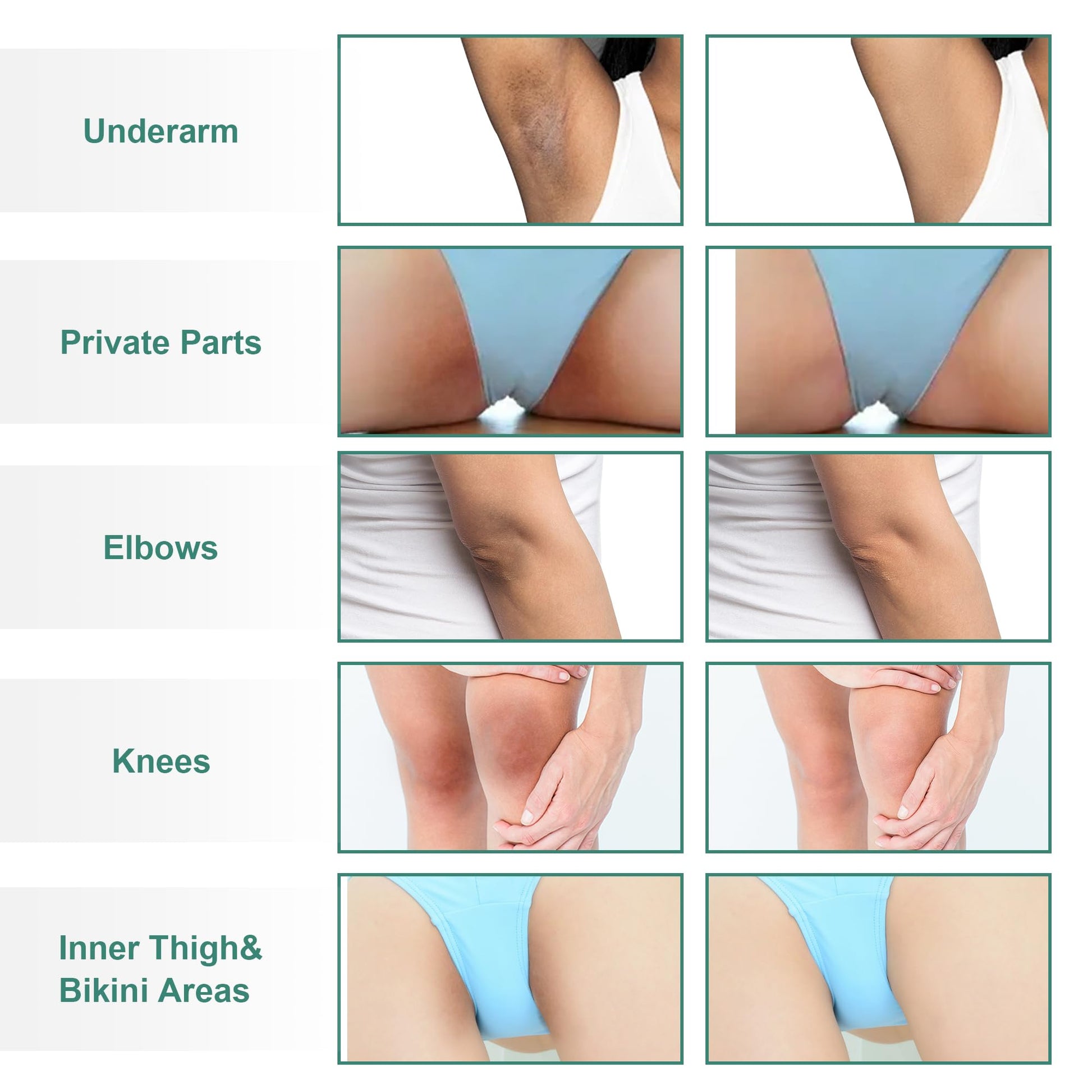 Vcetree Skin Bleaching Cream Skin Lightening for Body Intimate Areas, Private Parts, Underarm, Knees, Elbows, Inner Thigh, Bikini Area - PrimeBioHealth - canada supplements
