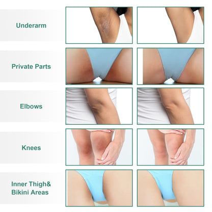 Vcetree Skin Bleaching Cream Skin Lightening for Body Intimate Areas, Private Parts, Underarm, Knees, Elbows, Inner Thigh, Bikini Area - PrimeBioHealth - canada supplements